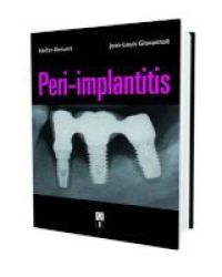 Peri-implantitis Hardcover