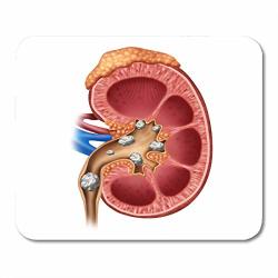 Emvency Mouse Pads Kidney Stones Medical As Human Organ Painful Crystaline Mineral Formations Symbol Cross Section 3D Mouse Pad Mats 9.5" X 7.9" For